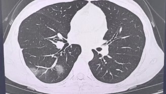 查出流感没在意，女子硬扛三天后肺都“白”了……