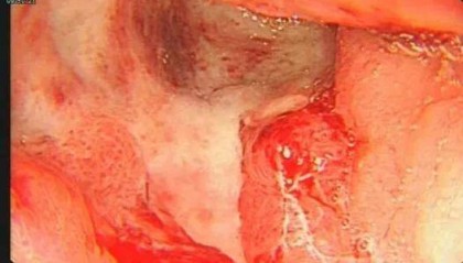 24岁女演员确诊“癌王”,崩溃痛悔:大家别像我这样