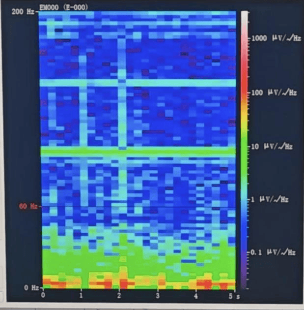 山西首例！山西省人民医院成功实施脑机接口辅助功能区脑肿瘤切除手术
