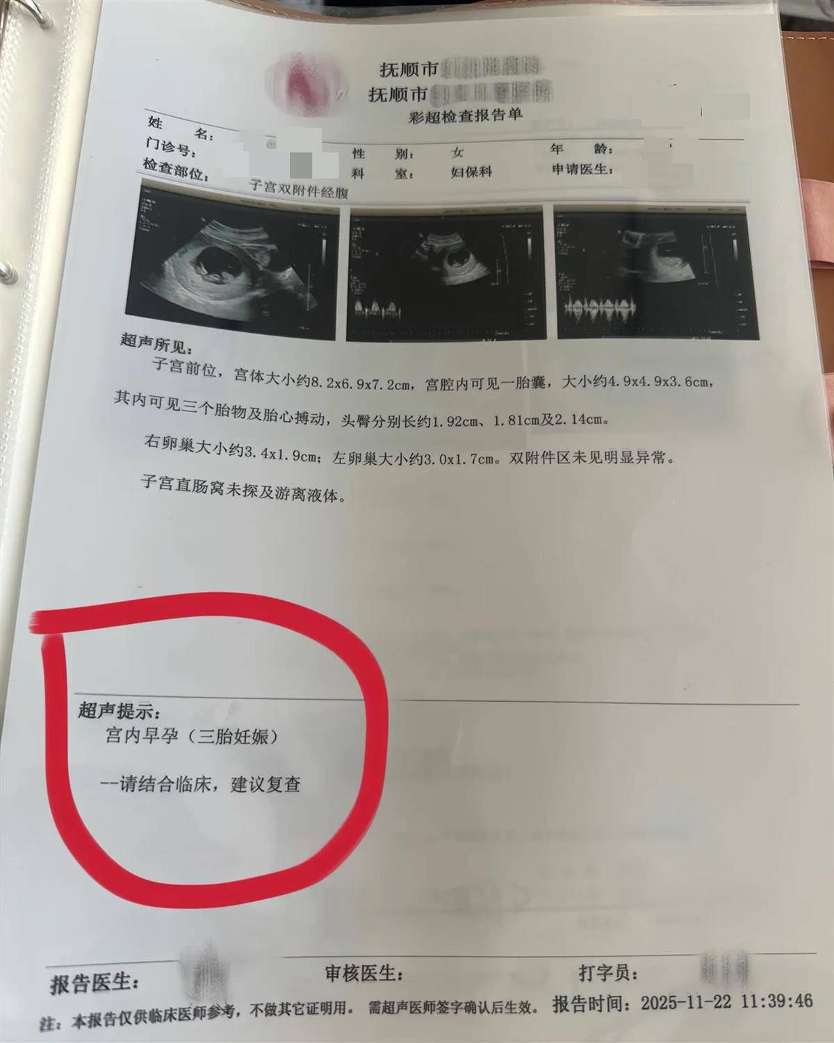 辽宁一孕妇两个月内从一胎变四胞胎,每次产检发现多出一胎,医生:系同卵四胞胎,概率1300万至1500万分之一