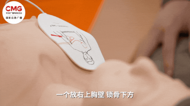 山东一市民突发心梗,其家属砸窗取出陌生人车内AED用于急救;车主回应:砸就砸吧,人命比玻璃重要