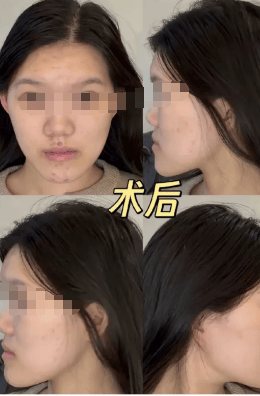 24岁女孩正颌手术被做反成“鞋拔子脸”,武汉大学口腔医院通报:已成立专项调查组,当事医生已停诊配合调查